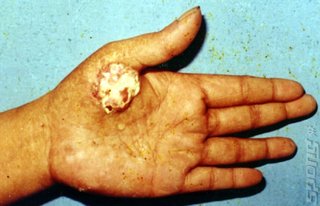 Arsenic lesions on hand. Not caused by video games... 